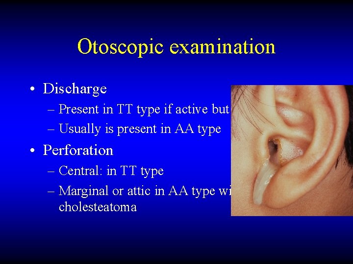 Otoscopic examination • Discharge – Present in TT type if active but may be
