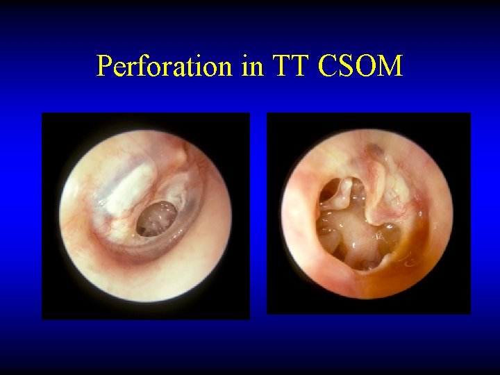 Perforation in TT CSOM 
