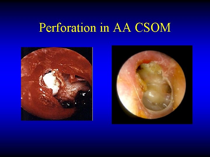 Perforation in AA CSOM 