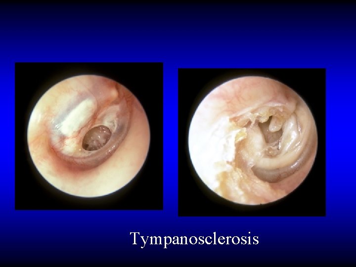 Tympanosclerosis 