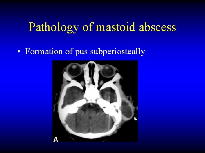 Pathology of mastoid abscess • Formation of pus subperiosteally 