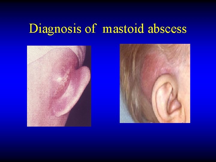 Diagnosis of mastoid abscess 