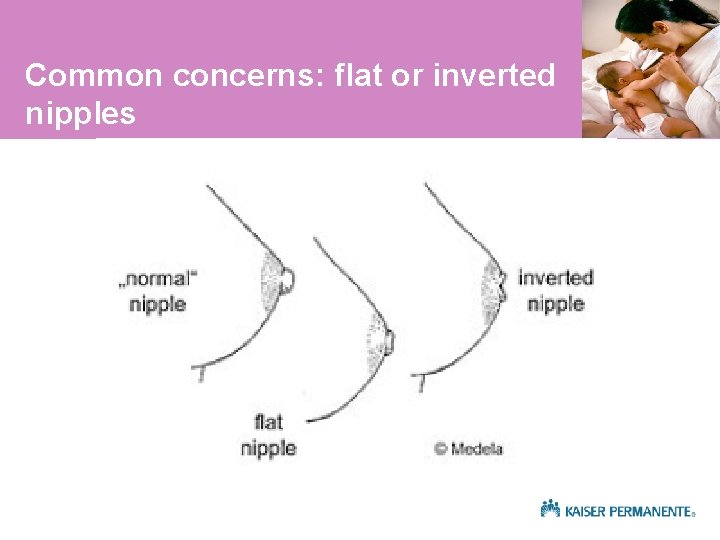 Common concerns: flat or inverted nipples 
