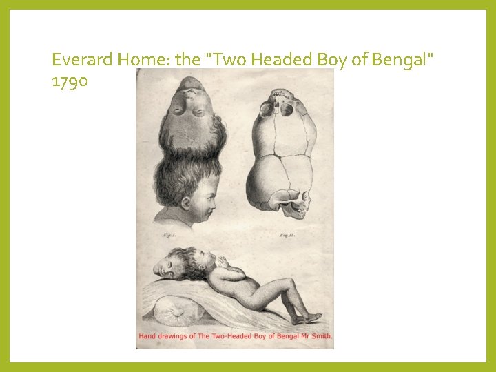 Everard Home: the "Two Headed Boy of Bengal" 1790 