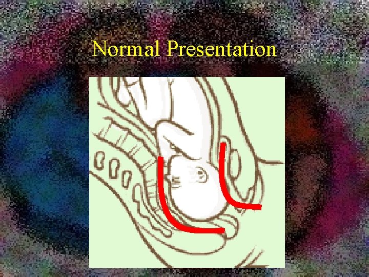 Normal Presentation 