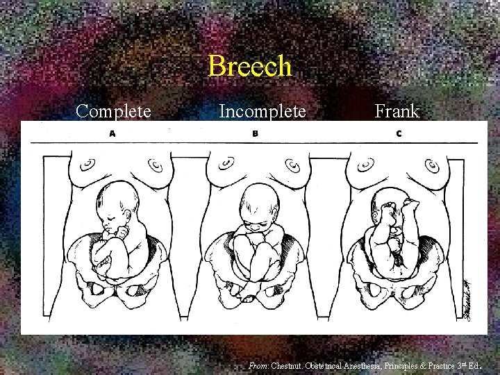 Breech Complete Incomplete Frank From: Chestnut. Obstetrical Anesthesia, Principles & Practice 3 rd Ed