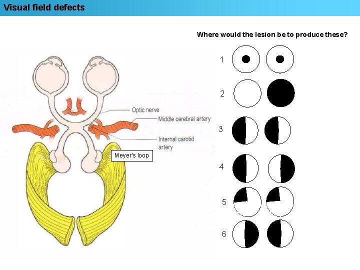 Visual field defects Where would the lesion be to produce these? 1 2 3