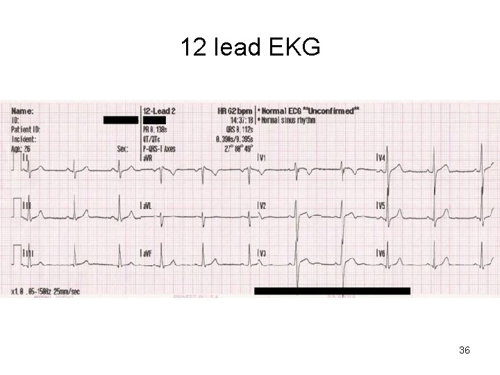 12 lead EKG 36  12 lead EKG 36