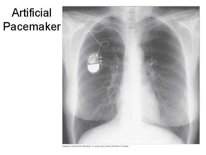 Artificial Pacemaker 37  Artificial Pacemaker 37