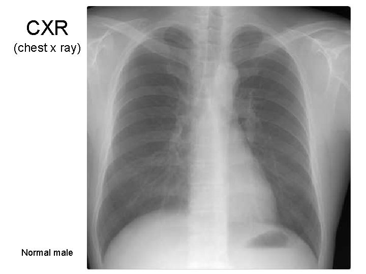 CXR (chest x ray) Normal male 7  CXR (chest x ray) Normal male 7