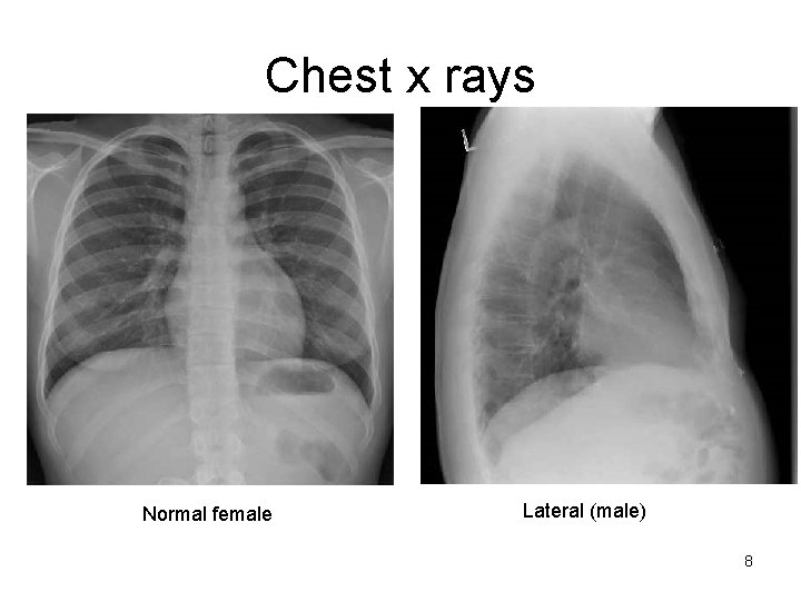 Chest x rays Normal female Lateral (male) 8  Chest x rays Normal female Lateral (male) 8