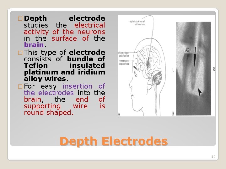 � Depth electrode studies the electrical activity of the neurons in the surface of