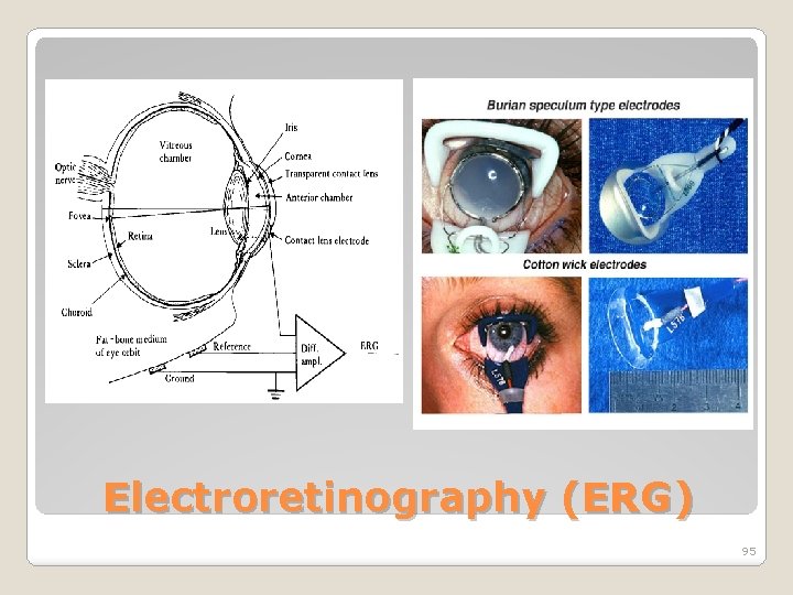 Electroretinography (ERG) 95 