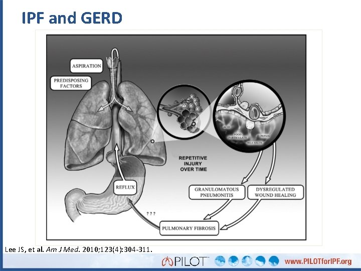 IPF and GERD Lee JS, et al. Am J Med. 2010; 123(4): 304 -311.