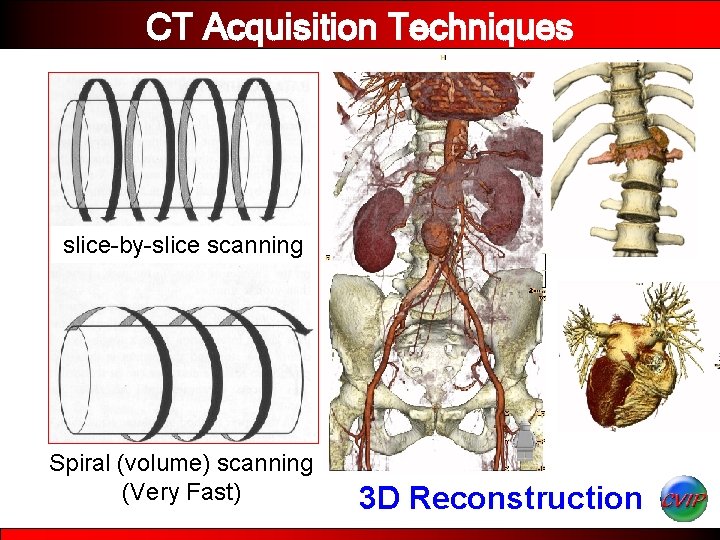 CT Acquisition Techniques slice-by-slice scanning Spiral (volume) scanning (Very Fast) 3 D Reconstruction 