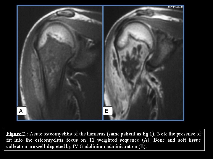 A B Figure 7 : Acute osteomyelitis of the humerus (same patient as fig