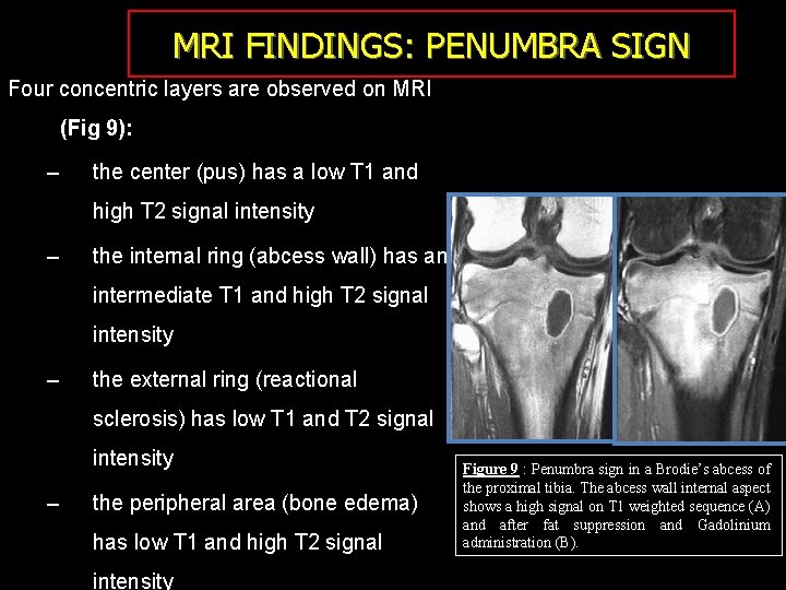 MRI FINDINGS: PENUMBRA SIGN Four concentric layers are observed on MRI (Fig 9): –