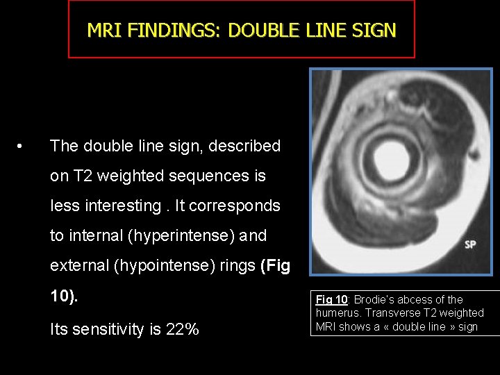 MRI FINDINGS: DOUBLE LINE SIGN • The double line sign, described on T 2