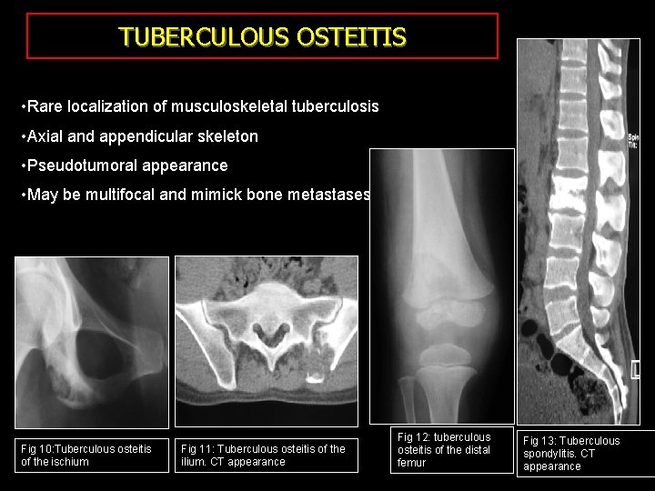 TUBERCULOUS OSTEITIS • Rare localization of musculoskeletal tuberculosis • Axial and appendicular skeleton •