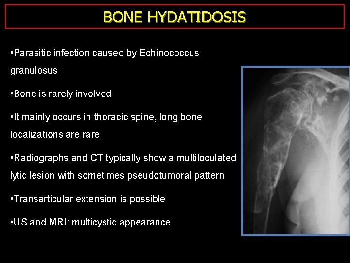 BONE HYDATIDOSIS • Parasitic infection caused by Echinococcus granulosus • Bone is rarely involved