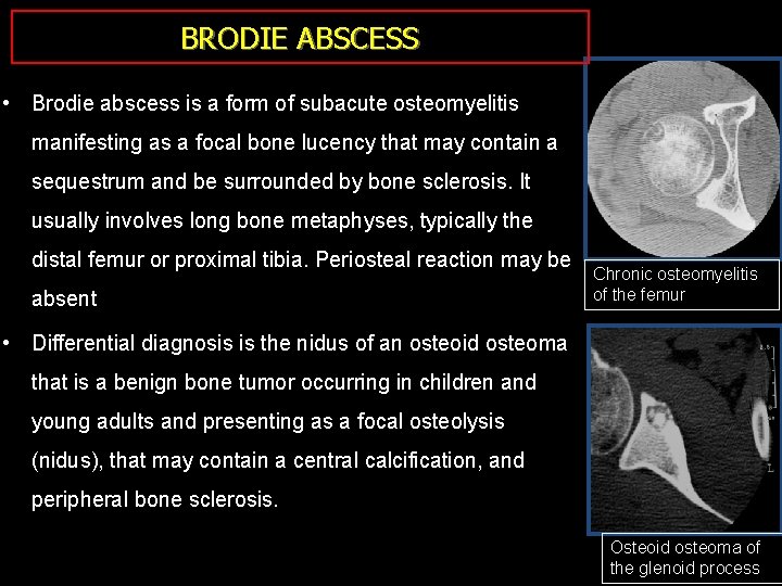 BRODIE ABSCESS • Brodie abscess is a form of subacute osteomyelitis manifesting as a