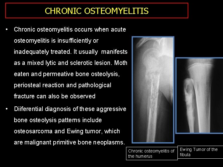 CHRONIC OSTEOMYELITIS • Chronic osteomyelitis occurs when acute osteomyelitis is insufficiently or inadequately treated.
