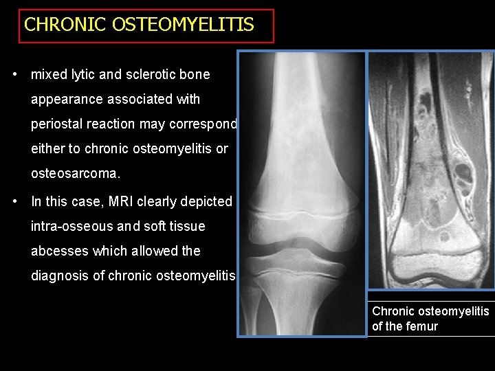 CHRONIC OSTEOMYELITIS • mixed lytic and sclerotic bone appearance associated with periostal reaction may