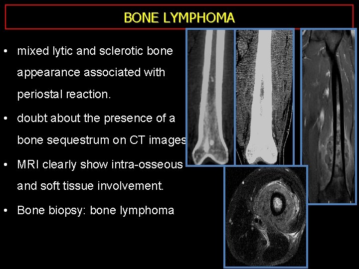 BONE LYMPHOMA • mixed lytic and sclerotic bone appearance associated with periostal reaction. •