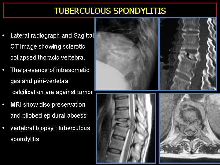 TUBERCULOUS SPONDYLITIS • Lateral radiograph and Sagittal CT image showing sclerotic collapsed thoracic vertebra.