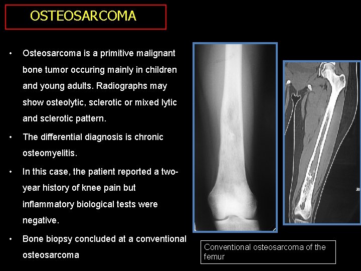 OSTEOSARCOMA • Osteosarcoma is a primitive malignant bone tumor occuring mainly in children and