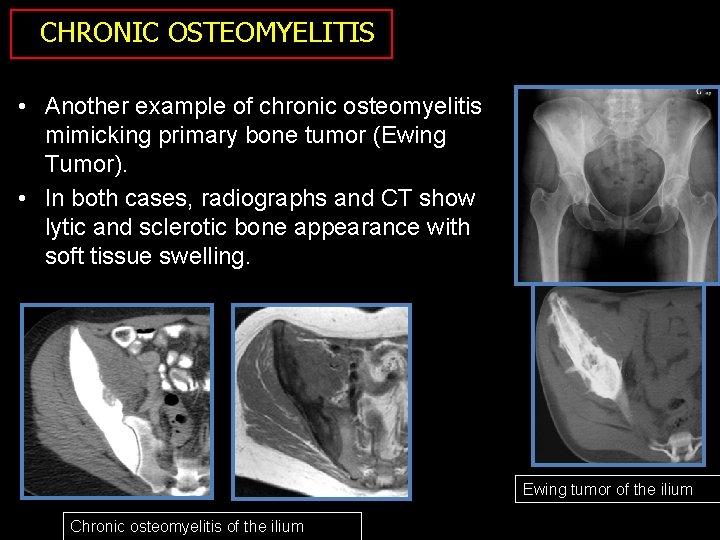 CHRONIC OSTEOMYELITIS • Another example of chronic osteomyelitis mimicking primary bone tumor (Ewing Tumor).