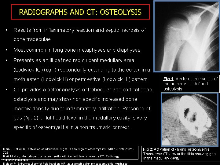 RADIOGRAPHS AND CT: OSTEOLYSIS • Results from inflammatory reaction and septic necrosis of bone