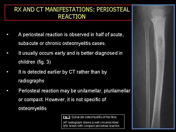RX AND CT MANIFESTATIONS: PERIOSTEAL REACTION • A periosteal reaction is observed in half