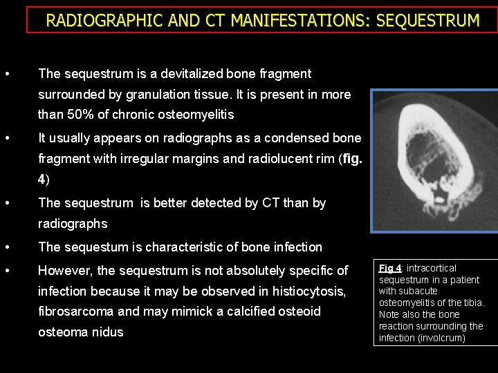 RADIOGRAPHIC AND CT MANIFESTATIONS: SEQUESTRUM • The sequestrum is a devitalized bone fragment surrounded