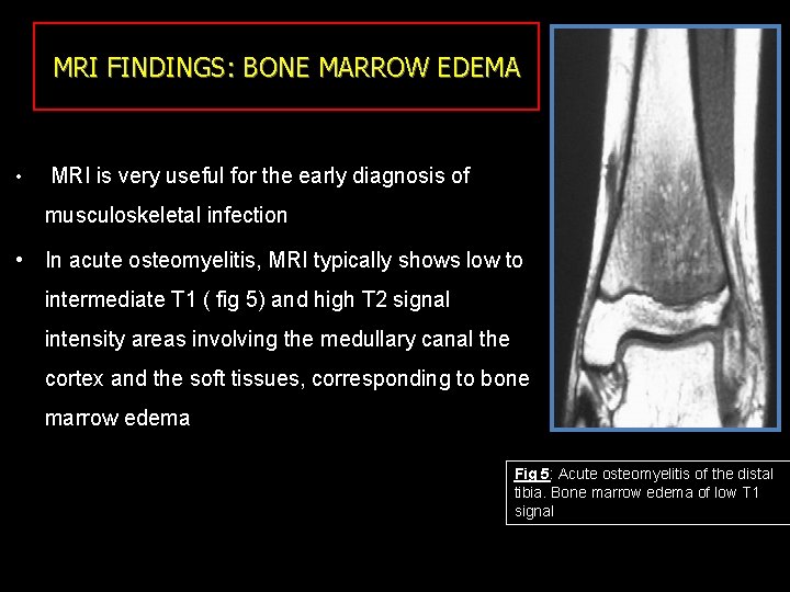 MRI FINDINGS: BONE MARROW EDEMA • MRI is very useful for the early diagnosis