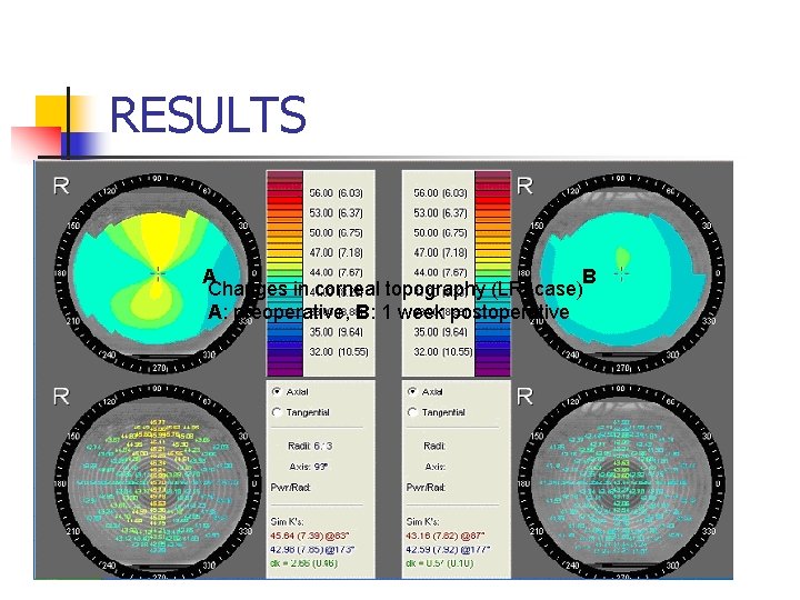 RESULTS A B Changes in corneal topography (LRI case) A: preoperative, B: 1 week