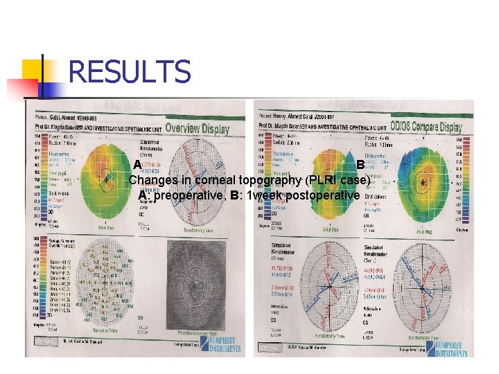 RESULTS A B Changes in corneal topography (PLRI case) A: preoperative, B: 1 week