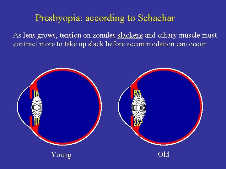Presbyopia: according to Schachar As lens grows, tension on zonules slackens and ciliary muscle