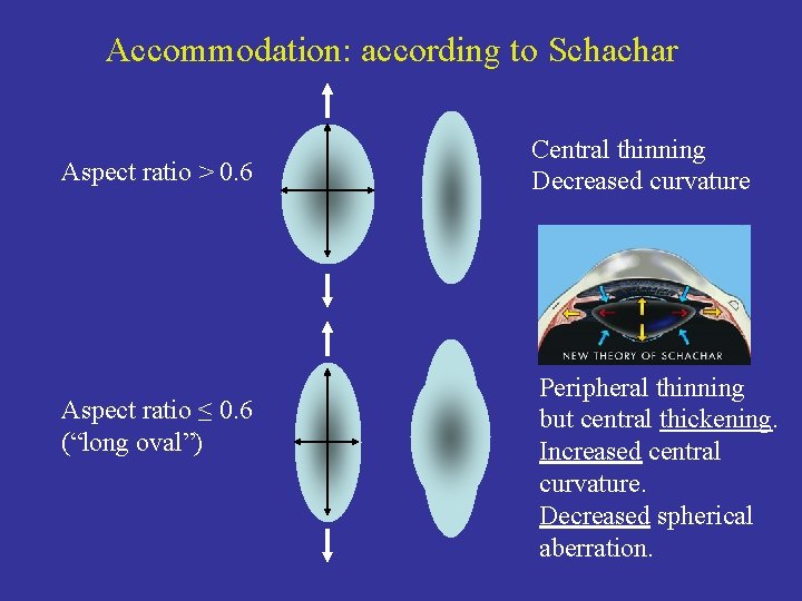 Accommodation: according to Schachar Aspect ratio > 0. 6 Aspect ratio ≤ 0. 6