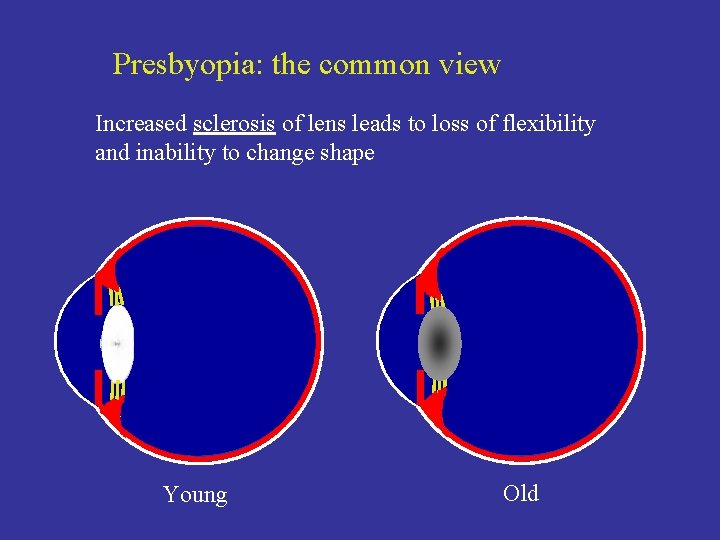 Presbyopia: the common view Increased sclerosis of lens leads to loss of flexibility and