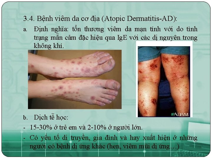 3. 4. Bệnh viêm da cơ địa (Atopic Dermatitis-AD): a. Định nghĩa: tổn thương