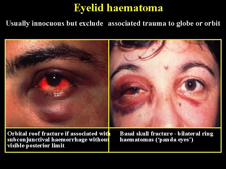 Eyelid haematoma Usually innocuous but exclude associated trauma to globe or orbit Orbital roof