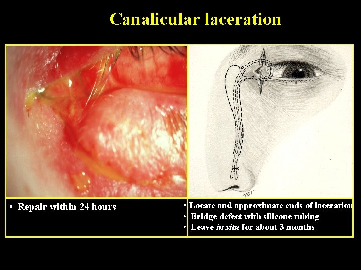 Canalicular laceration • Repair within 24 hours • Locate and approximate ends of laceration