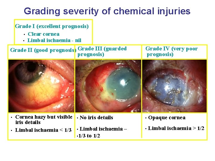 Grading severity of chemical injuries Grade I (excellent prognosis) • • Clear cornea Limbal