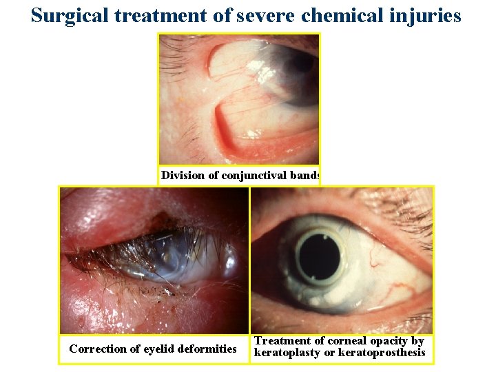 Surgical treatment of severe chemical injuries Division of conjunctival bands Correction of eyelid deformities