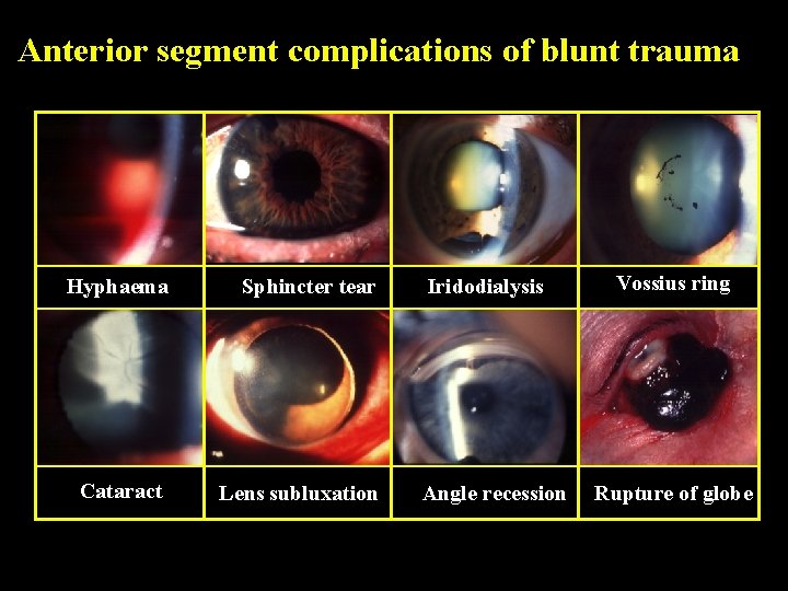Anterior segment complications of blunt trauma Hyphaema Sphincter tear Cataract Lens subluxation Iridodialysis Angle