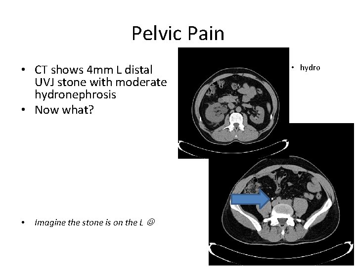 Pelvic Pain • CT shows 4 mm L distal UVJ stone with moderate hydronephrosis