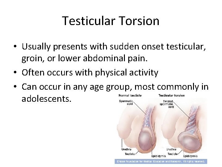 Testicular Torsion • Usually presents with sudden onset testicular, groin, or lower abdominal pain.