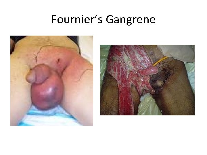 Fournier’s Gangrene 