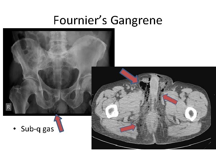 Fournier’s Gangrene • Sub-q gas 